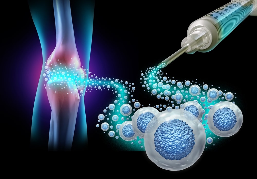 Mesenchymal Stem Cell Therapy in Mexico